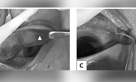 Bác sĩ phát hiện giun sống dưới mí mắt của một phụ nữ