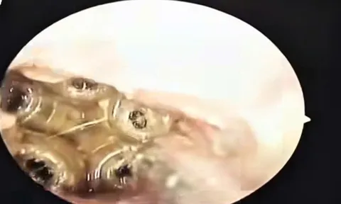 Nữ bệnh nhân nhập viện vì đau tai, bác sĩ gắp ra 5 con giòi sống