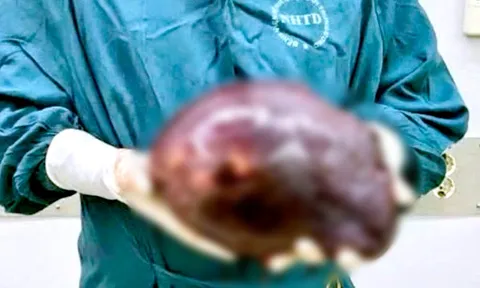 Cắt khối u gan khổng lồ nặng 2,5kg