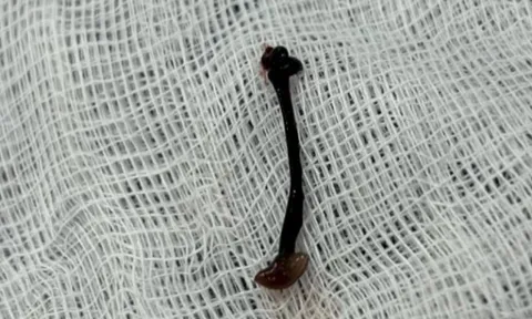 Bé trai chảy máu mũi cả tuần vì con vắt sống ký sinh trong hốc mũi