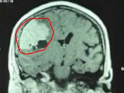 Đau đầu kéo dài vì khối u màng não 'khổng lồ'