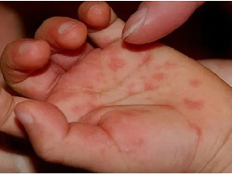 Bé trai một tuổi tử vong sau nhiều ngày sốt li bì vì bệnh tay chân miệng