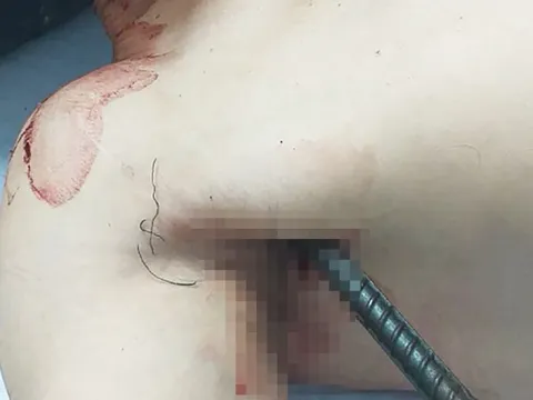 Cứu nam thanh niên bị 2 thanh sắt xuyên qua người