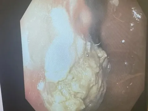 Điều gì xảy ra khi đứa trẻ 5 tuổi nuốt 40 chiếc kẹo cao su?