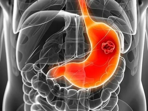 Bác sĩ chỉ cách ăn uống ngừa ung thư dạ dày