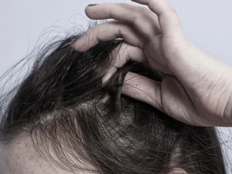 Thói quen thích nhổ tóc có thể là bệnh lý tâm thần?